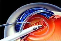 cirugiadecataratafacoemulsificacion