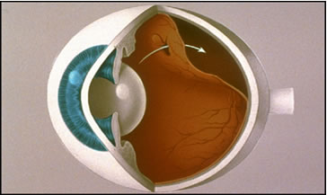 Retinopatía Diabética 1 Que es la Retinopatia | Khroma Vision | Oftalmologos Monterrey
