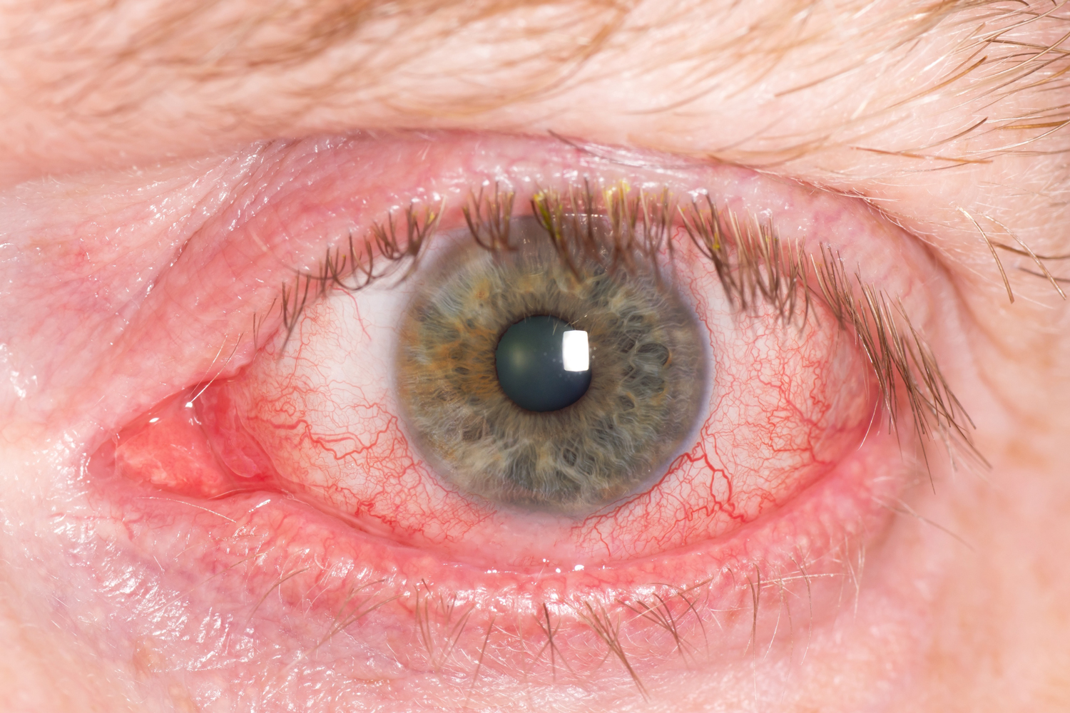 Khroma Visión | Glaucoma - Oftalmologo Especialista en Glaucoma - Tratamiento Glaucoma