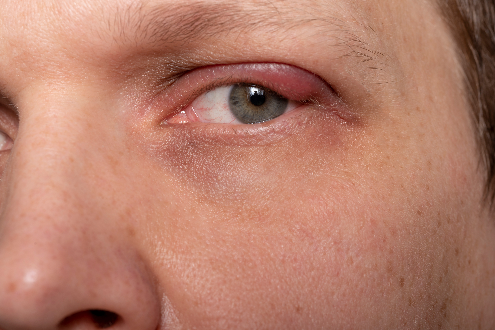 Chalazion | Khroma Visión | Oftalmologos Especialistas - Cirugía de Ojos - Cirugia de Cataratas - Cirugía de Ojos Monterrey