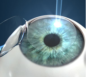 Cirugía LASIK 9